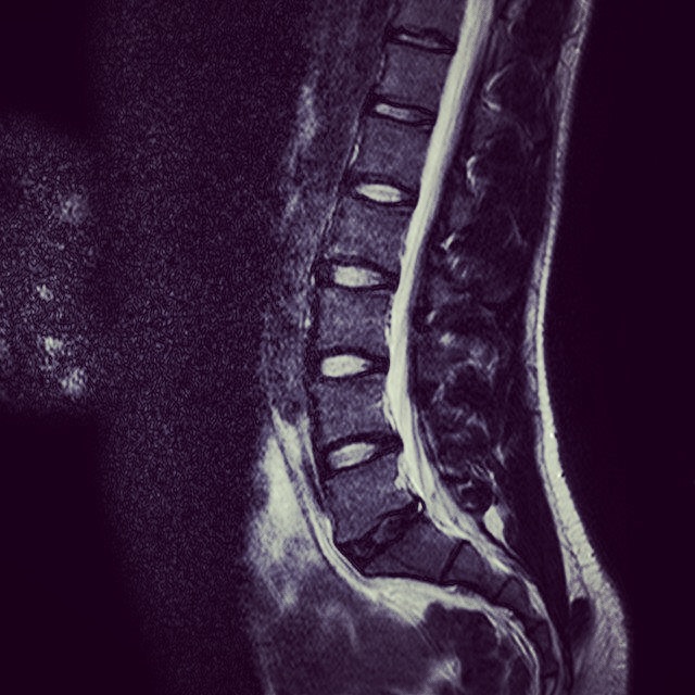 Back Pain - Is Movement the best medicine? Back Pain – Is Movement the best medicine?